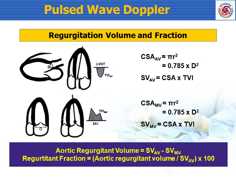 Pulsed Wave Doppler Regurgitation Volume and Fraction Aortic Regurgitant Volume = SVAV - SVMV